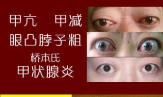 桥本氏甲状腺炎中医治疗